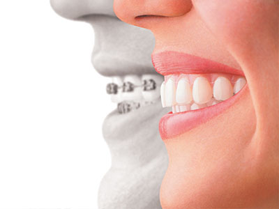 Straight Smiles Orthodontics | Teeth Whitening, Adult Orthodontics and Clear Ceramic Braces